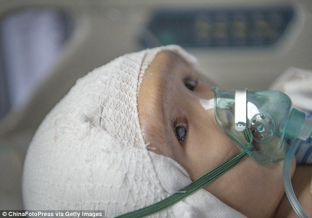 Trasplantan cráneo impreso en 3D a niña china con hidrocefalia - 2A93934900000578-3163478-image-m-19_1437042539414