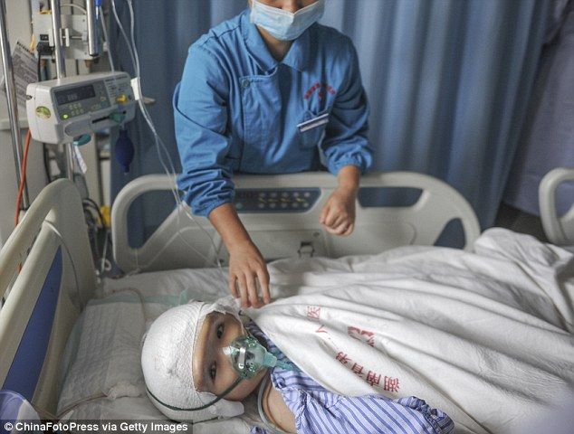 Trasplantan cráneo impreso en 3D a niña china con hidrocefalia - 2A93941900000578-3163478-image-m-21_1437042566257