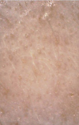 Los efectos de consumir comida rápida por una semana - comida_rapida_piel1